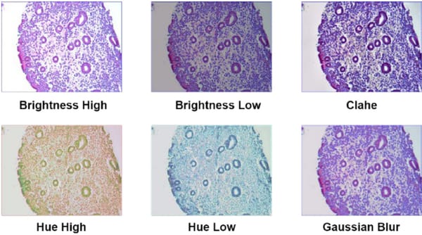 AI diagnoses major cancer with near perfect accuracy